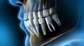 Dental Implants